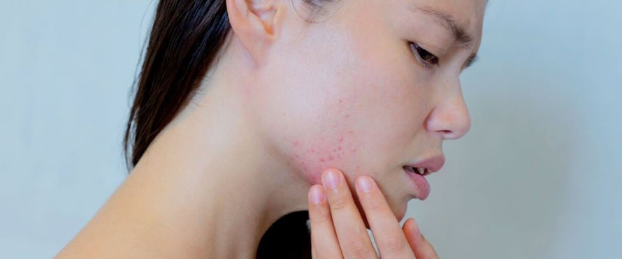 acne-fighting skincare routine